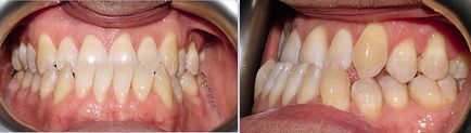 Мезіальний прикус 15 фото до і після лікування