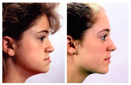 Mesial mușcă 15 fotografii înainte și după tratament