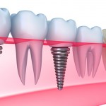 Mesial mușcă 15 fotografii înainte și după tratament