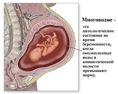 Polyhydramnios în timpul sarcinii cauze, tratament, și aftereffects