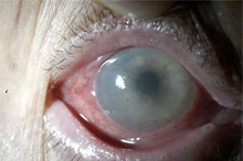 Microchirurgie Mntk a ochiului, numită Fedorova, cornea ereditară