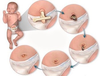 Este posibil să se spele copilul cu cordonul ombilical neprotejat