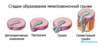 MRI diagnózis nyaki gerinc - leírás és címét klinikák