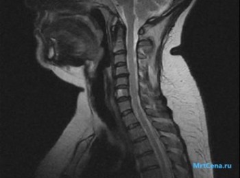 MRI diagnózis nyaki gerinc - leírás és címét klinikák