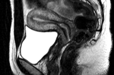 MRI a méh és a petefészkek