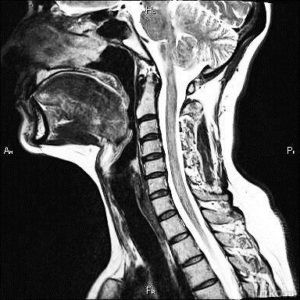 Mert a coloanei vertebrale cervicale