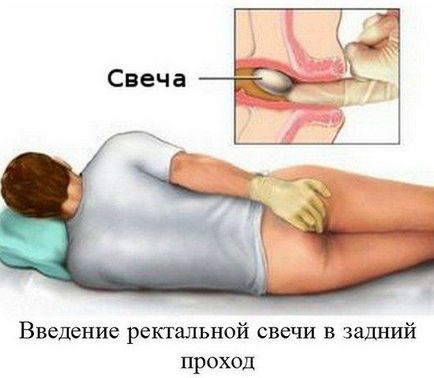 Lumânări de cătină (rectal) de la constipație - instrucțiuni de utilizare, recenzii