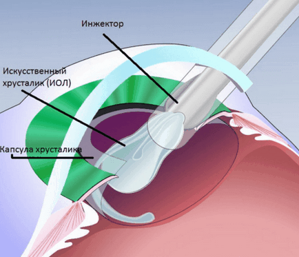 Chirurgie pentru a elimina costul ochiului cataractei, recenzii
