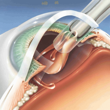 Операція з видалення катаракти очі вартість, відгуки