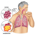 Complicațiile pneumoniei la adulți din cauza pneumoniei bilaterale