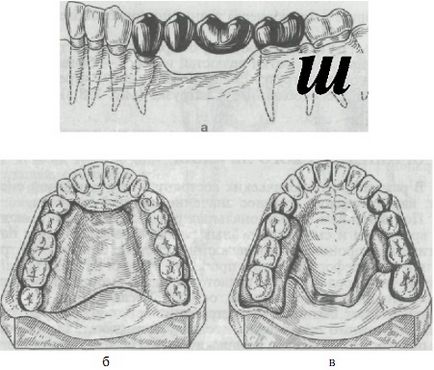 Fundamentele tratamentului ortopedic pentru adenine parțiale secundare - stomatologie ortopedică,