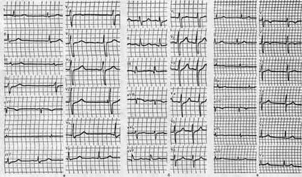 Inima pulmonară acută - modificări ek - studiul activității electrice a inimii -