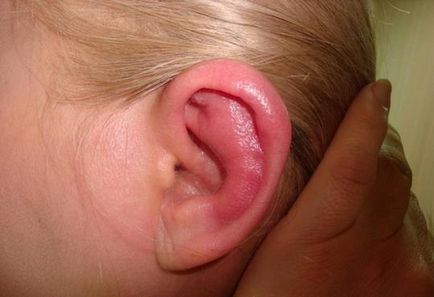 Набряк вуха що робити, причини, симптоми і лікування, чим небезпечний