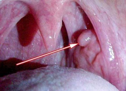 Papilloma în simptomele gâtului, cauzele și tratamentul bolii - informații despre sănătate