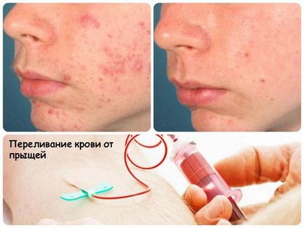 Transfuzie de sânge de la acnee acnee, blackheads, la domiciliu, autohemoterapie, înainte și după fotografii,