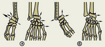 Fractura de simptome ale oaselor antebratului, diagnostic, tratament