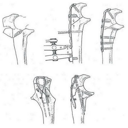 Fractura de simptome ale oaselor antebratului, diagnostic, tratament