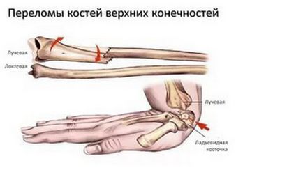 Fractura de simptome ale oaselor antebratului, diagnostic, tratament