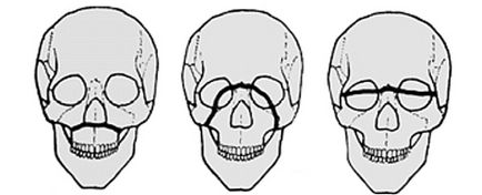 Fractura tratamentului oaselor faciale, simptome și semne timpurii