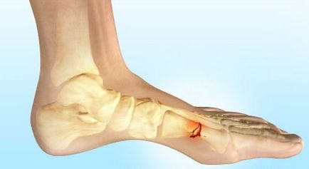 Fractura de clasificare a piciorului, cauze, simptome și tratament
