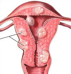 De ce există o adenomie a uterului, tratamentul cancerului și prevenirea acestuia