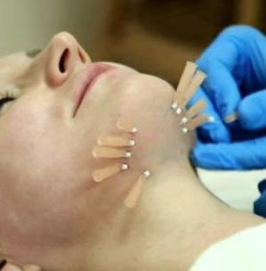 Facelift fara chirurgie, acid hialuronic