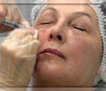 Facelift fara chirurgie, acid hialuronic