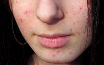 Megfázás pattanások az arcon okok és a kezelés