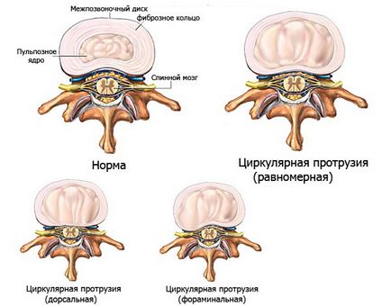 Protruzia discurilor intervertebrale circulare și difuze, regiuni cervicale și lombare, tratament