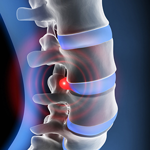 Protruzia discurilor intervertebrale circulare și difuze, regiuni cervicale și lombare, tratament