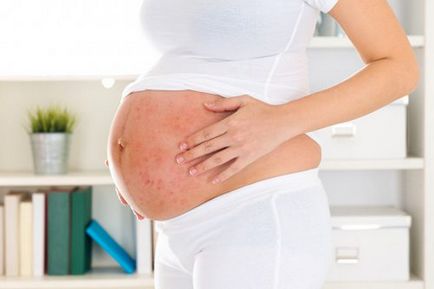 Pikkelysömör kezelésére terhesség és szoptatás