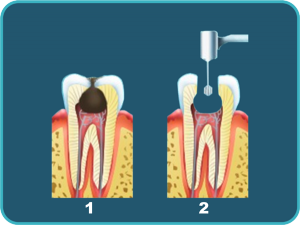 Pulpita - cauze, simptome, tratament