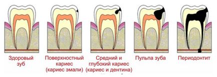 Dental din cep - ceea ce este, simptome, cauze, tratament, complicații