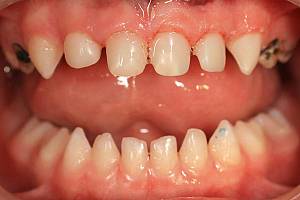 Реставрація молочних зубів