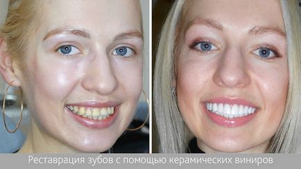 Реставрація зубів, види, показання та протипоказання