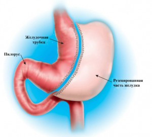 Refacerea stomacului