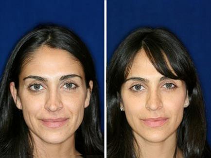 Rinoplastia non-operative comentarii, foto