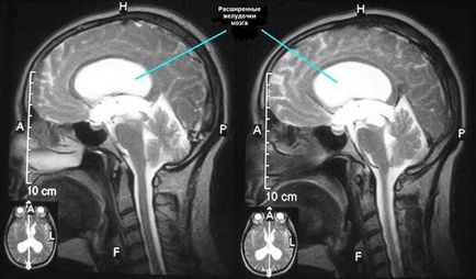 Tolatási cerebrovascularis hydrocephalus műtét következményei pálmalevél és Maya - Egészség