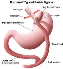 Cabinetul de by-pass gastric în Israel - preț, operație laparoscopică, medicamentul b5