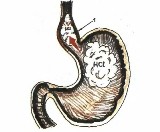Симптоми виразки шлунка і дванадцятипалої кишки