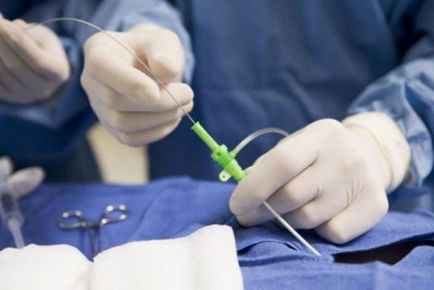 Term műtétek utáni rehabilitációra varicocele meg kell tudni, uflebologa (rehabilitációs időszak a műtét után varicocele) Term műtétek utáni rehabilitációra varicocele meg kell tudni, uflebologa