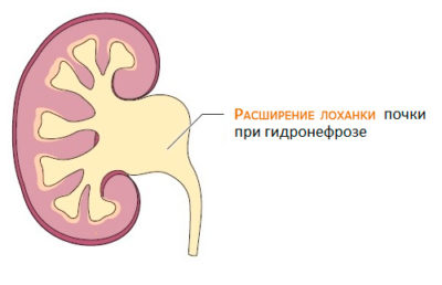 Chistul subcapsular al rinichiului stang este ceea ce este si cum sa-l tratezi