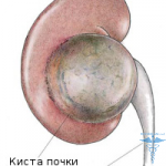 Chistul subcapsular al rinichiului (dreapta și stânga)