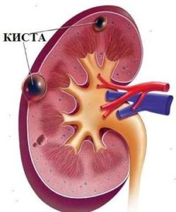 Субкапсулиран киста на бъбрека, симптоми, диагностика и лечение