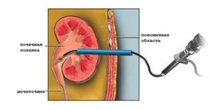 Subcapsular simptome de rinichi chist, diagnostic și tratament