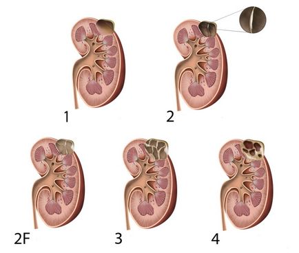 Субкапсулярна кіста правої нирки - розвиток і класифікація