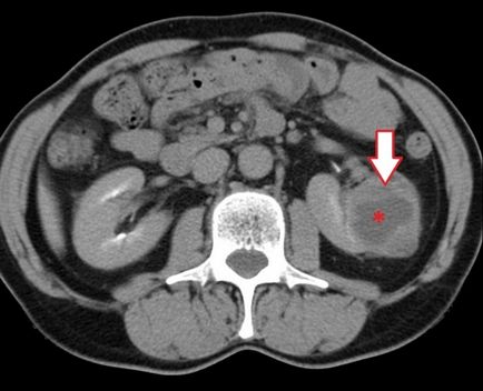 Chistul subcapsular al dezvoltării și clasificării rinichiului drept