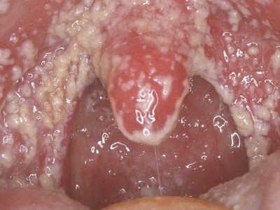 A hőmérsékletet stomatitis gyermekek és felnőttek, mit kell tennie (gyermek) A hőmérsékletet stomatitis gyermekek és felnőttek, mit kell tenni