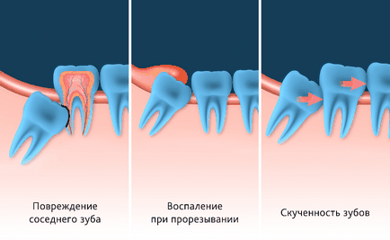 Pentru a îndepărta sau a lăsa dinții de înțelepciune, nord dentar