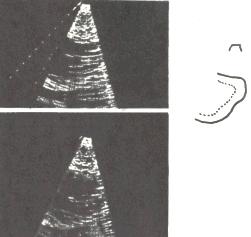 Diagnosticul ultrasonic în cardiologie